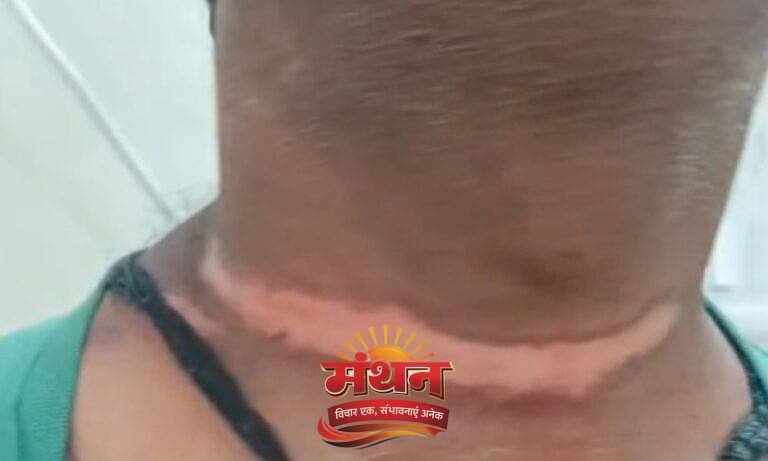 (कोरबा) लहराती रस्सी फंसी गले में-व्यवसायी घायल
