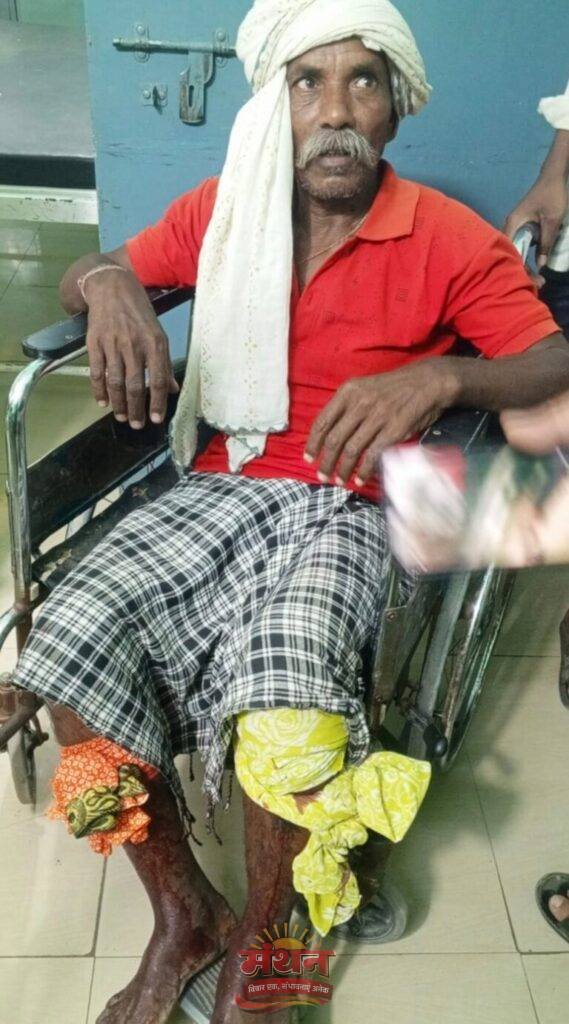 (कोरबा) तेंदूपत्ता तोड़ने जंगल गए दो ग्रामीणों पर भालू ने किया हमला