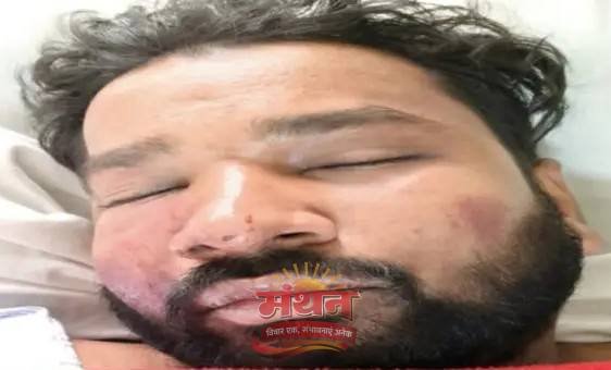 (कोरबा) अर्धरात्रि हुए खूनी बवाल में एएसआई का बेटा गंभीर घायल